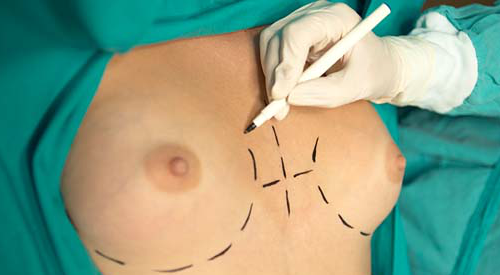 Operazione al seno - mastoplastica